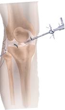 knee-arthroscopy