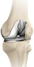 knee-replacement